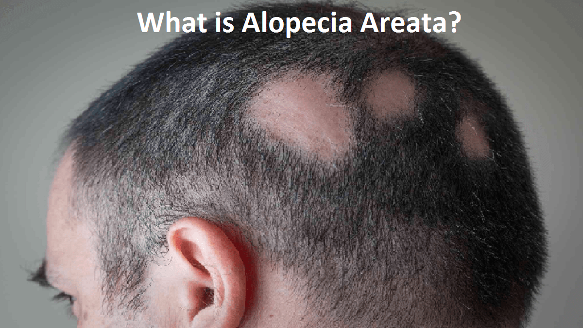 What is Alopecia Areata?